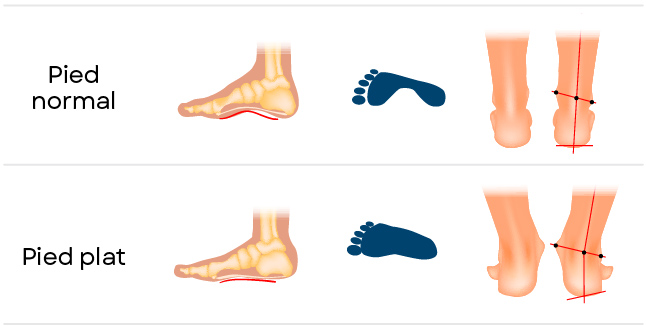 Illustration pieds plats vs pieds normaux